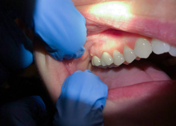 Best Emergency Tooth Extraction in Midway South, TX